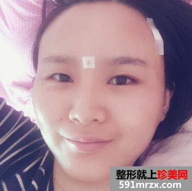 自体脂肪下巴填充前后对比图片