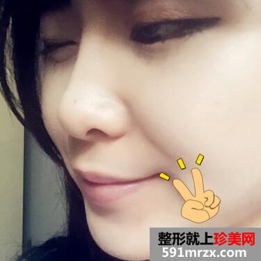 自体脂肪下巴填充前后对比图片