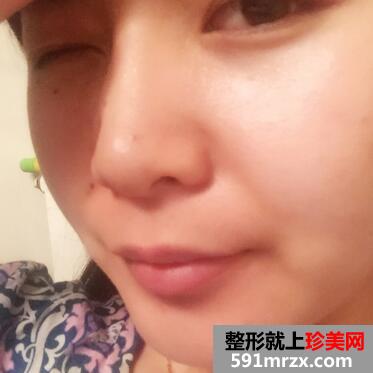 自体脂肪下巴填充前后对比图片