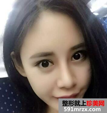 自体脂肪垫下巴对比 脂肪丰下巴恢复过程