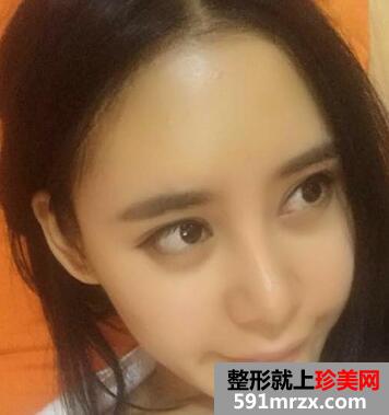 自体脂肪垫下巴对比 脂肪丰下巴恢复过程