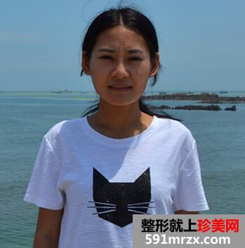 自体脂肪垫下巴对比 脂肪丰下巴恢复过程