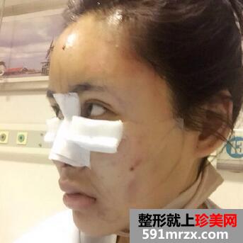 自体脂肪垫下巴对比 脂肪丰下巴恢复过程