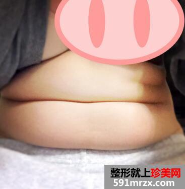 减肚子赘肉简单方法 腹部吸脂的亲身经历