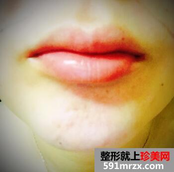 减肚子赘肉简单方法 腹部吸脂的亲身经历