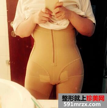 减肚子赘肉简单方法 腹部吸脂的亲身经历