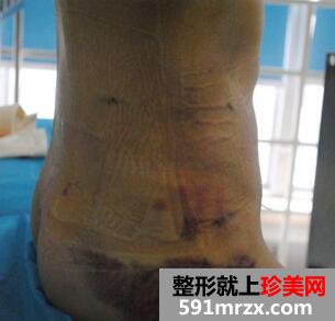 腰腹吸脂后1到7天图片