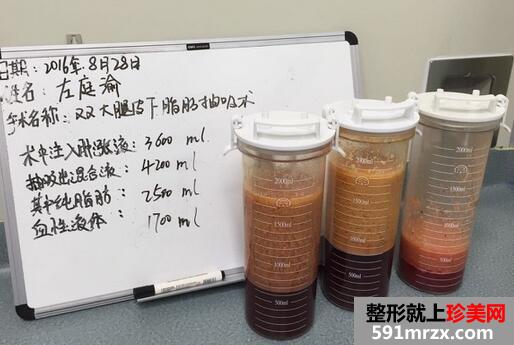 大腿抽脂后的恢复过程 大腿吸脂前后对比