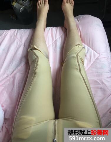 大腿抽脂后的恢复过程 大腿吸脂前后对比