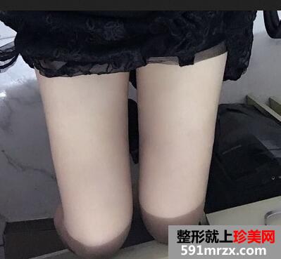 大腿抽脂后的恢复过程 大腿吸脂前后对比