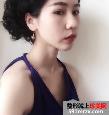 假体隆胸躺着会软吗 假体隆胸前后效果对比