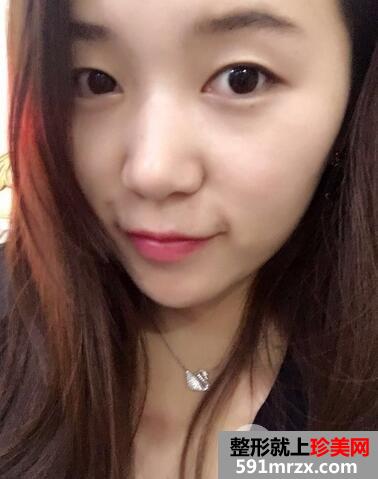 韩式三点双眼皮前后对比图 恢复过程分享
