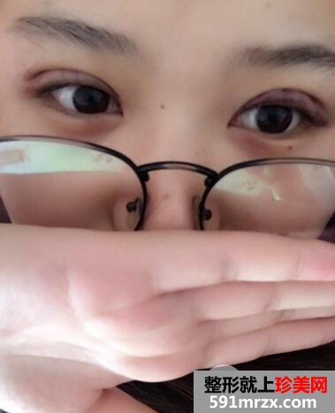 韩式三点双眼皮前后对比图 恢复过程分享