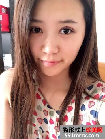 韩式三点双眼皮前后对比图 恢复过程分享