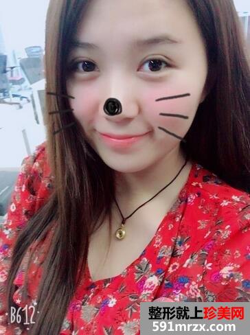 韩式三点双眼皮前后对比图 恢复过程分享