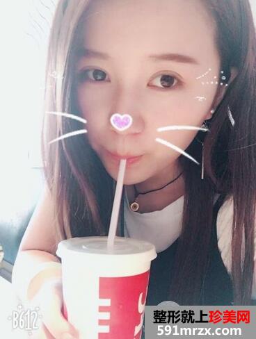 韩式三点双眼皮前后对比图 恢复过程分享