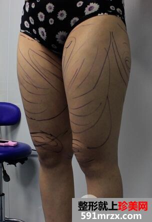 水动力吸脂瘦大腿前后对比照片