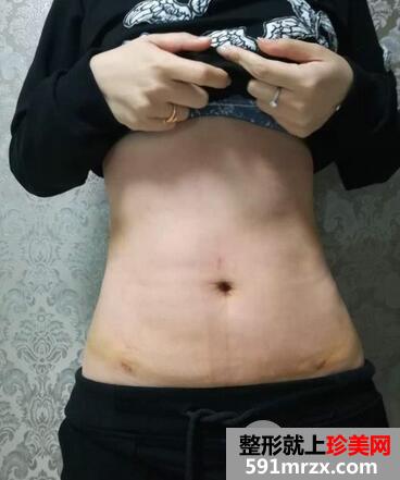 腰腹环吸效果好吗 亲身经历告诉你