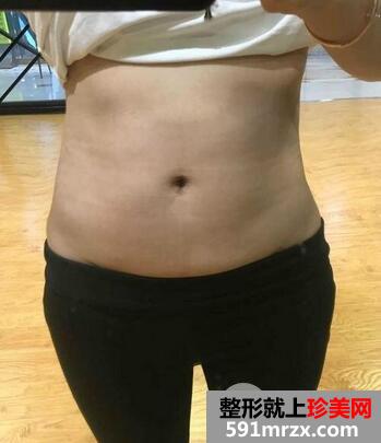 腰腹环吸效果好吗 亲身经历告诉你