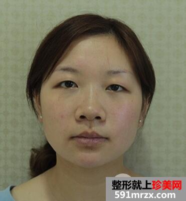 割双眼皮恢复图 前后效果对比