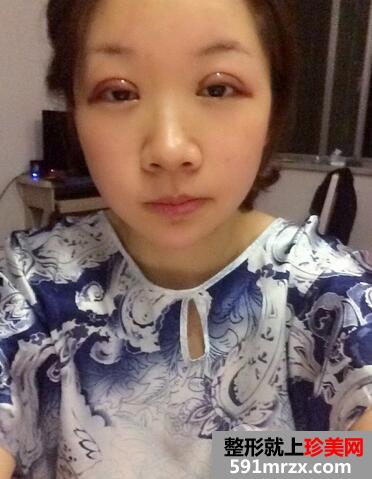 割双眼皮恢复图 前后效果对比