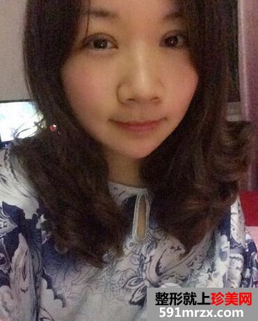 割双眼皮恢复图 前后效果对比
