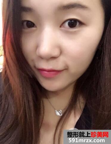 韩式三点双眼皮恢复图 萌妹子变女神
