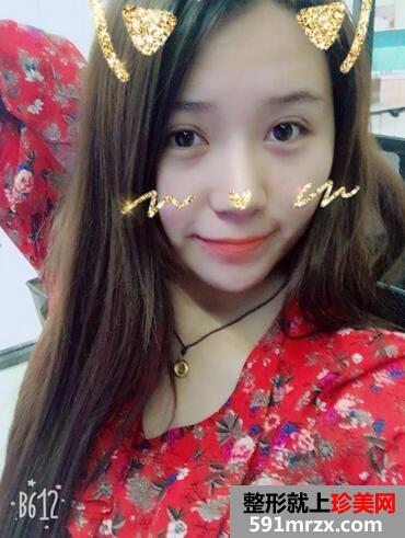 韩式三点双眼皮恢复图 萌妹子变女神