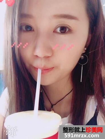 韩式三点双眼皮恢复图 萌妹子变女神