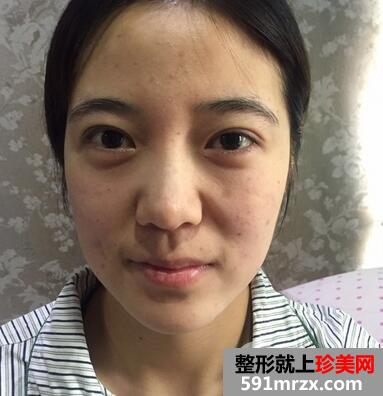 面颊吸脂+全面部脂肪填充效果分享