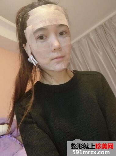 面颊吸脂+全面部脂肪填充效果分享