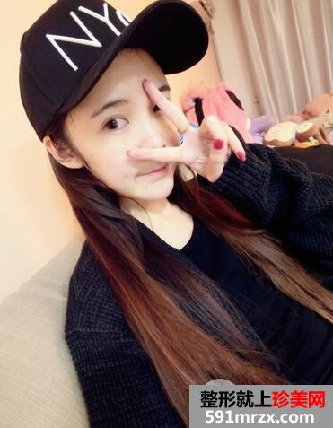 面颊吸脂+全面部脂肪填充效果分享