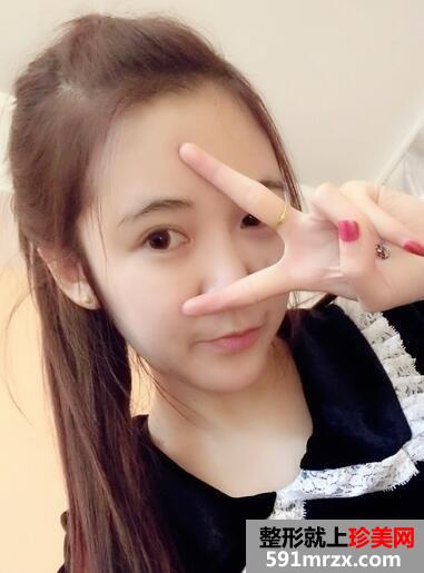 面颊吸脂+全面部脂肪填充效果分享