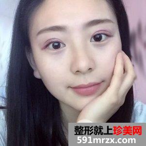 做切开双眼皮好恢复吗 切开双眼皮一个月恢复记录
