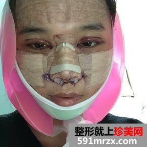 瓜子脸手术多少钱 V-LINE瓜子脸手术恢复记录