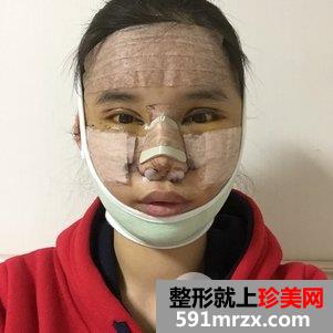 瓜子脸手术多少钱 V-LINE瓜子脸手术恢复记录