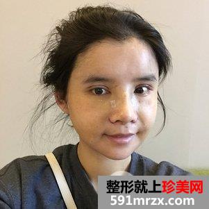 瓜子脸手术多少钱 V-LINE瓜子脸手术恢复记录