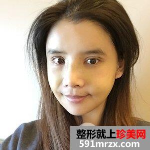 瓜子脸手术多少钱 V-LINE瓜子脸手术恢复记录