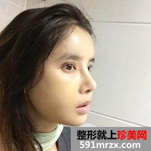 瓜子脸手术多少钱 V-LINE瓜子脸手术恢复记录