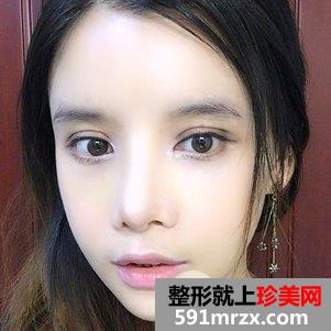 瓜子脸手术多少钱 V-LINE瓜子脸手术恢复记录