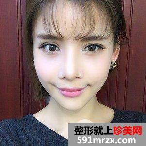 瓜子脸手术多少钱 V-LINE瓜子脸手术恢复记录