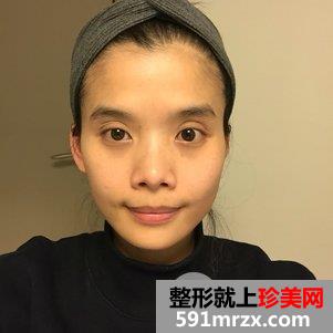 瓜子脸手术多少钱 V-LINE瓜子脸手术恢复记录