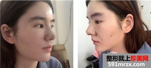 自体脂肪面部填充+鼻部综合整形 手术三个月恢复记录和前后对比照