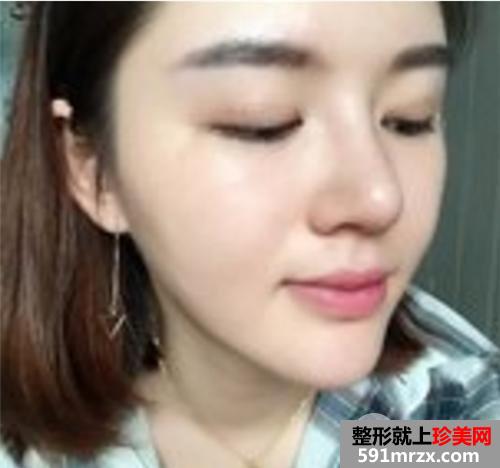 自体脂肪面部填充+鼻部综合整形 手术三个月恢复记录和前后对比照