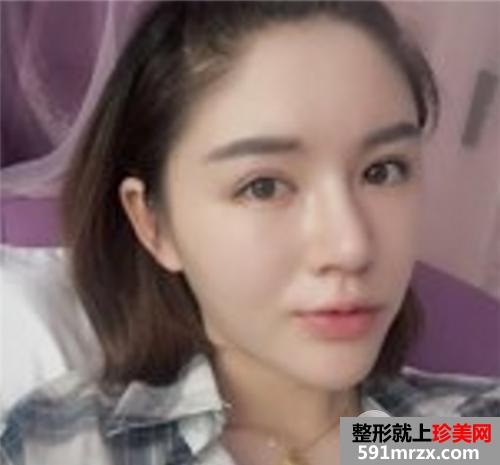 自体脂肪面部填充+鼻部综合整形 手术三个月恢复记录和前后对比照
