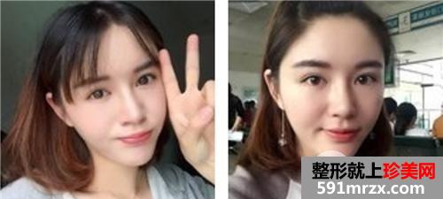 自体脂肪面部填充+鼻部综合整形 手术三个月恢复记录和前后对比照