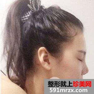鼻综合修复术后1个多月|附上整形前后对比图