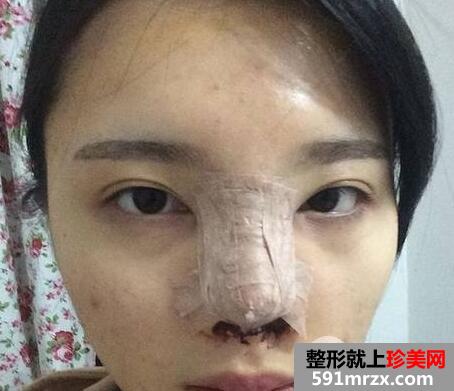 鼻综合修复术后1个多月|附上整形前后对比图