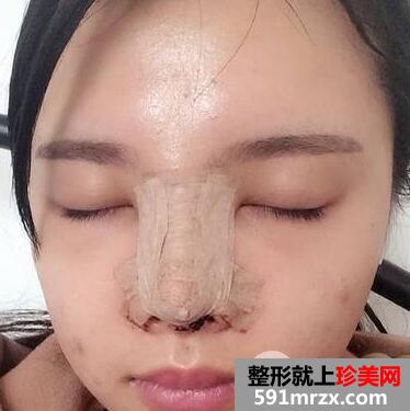 鼻综合修复术后1个多月|附上整形前后对比图