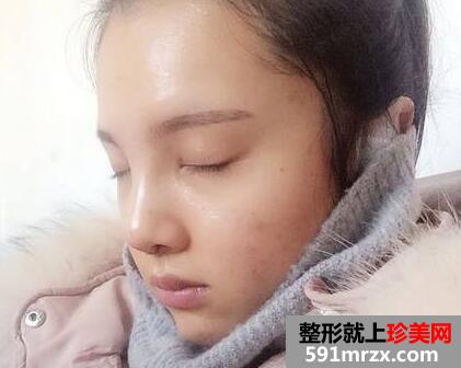 鼻综合修复术后1个多月|附上整形前后对比图